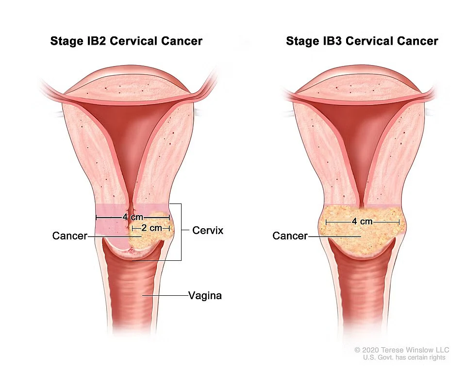 Cervical Cancer
