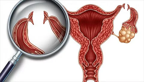 Cervical Cancer