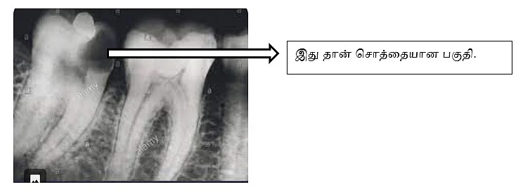 பல் சொத்தையை காண்பிக்கும் IOPA X Ray