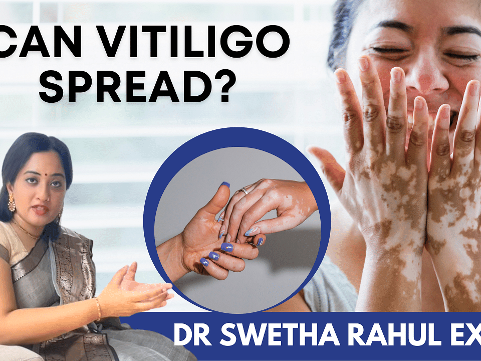 இந்த வயசுலதான் Vitiligo அதிகமா வரும்; அத Cure பண்ண முடியுமா? - Dr Swetha Rahul Explains | Doubts