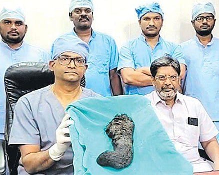சிறுமி வயிற்றிலிருந்த ஒரு கிலோ முடி; அனீமியாவால் பாதிக்கப்பட்டவர்கள் உஷார் - மருத்துவர் எச்சரிக்கை!