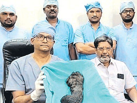 சிறுமி வயிற்றிலிருந்த ஒரு கிலோ முடி; அனீமியாவால் பாதிக்கப்பட்டவர்கள் உஷார் - மருத்துவர் எச்சரிக்கை!