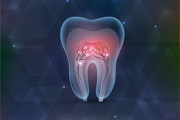  Root Canal சிகிச்சை