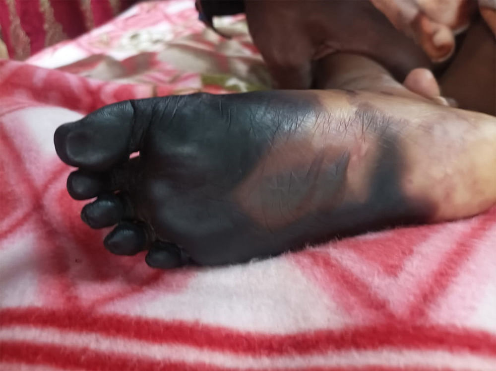 கருகிய வலது கால் பாதம்