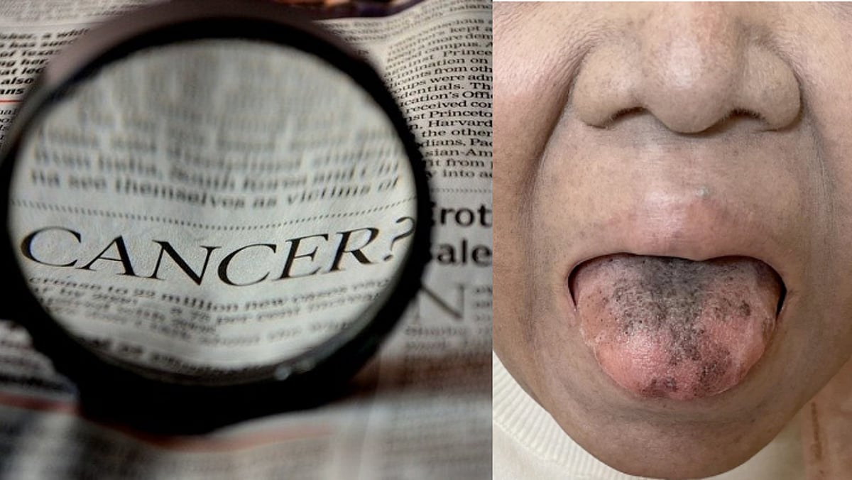 கேன்சர் சிகிச்சையில் தரப்பட்ட ஆன்டிபயாடிக்; முடி முளைத்து கறுப்பாக மாறிய நாக்கு... என்ன நடந்தது?