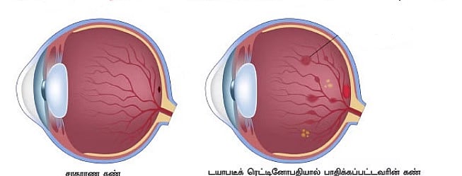 விழித்திரை