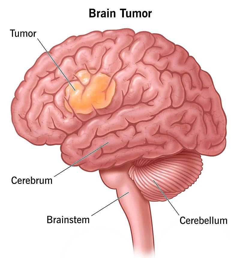 மூளைக் கட்டி