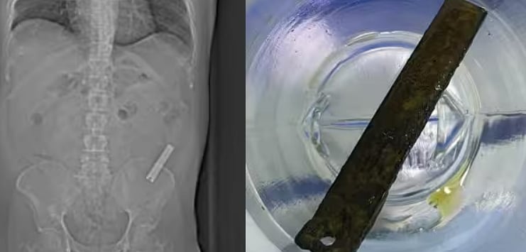 `திட்டுவாங்கன்னு வெளியே சொல்லல'- 8 வருடங்களாக இளைஞர் வயிற்றிலிருந்த நகவெட்டி; மிரண்ட மருத்துவர்கள்! 