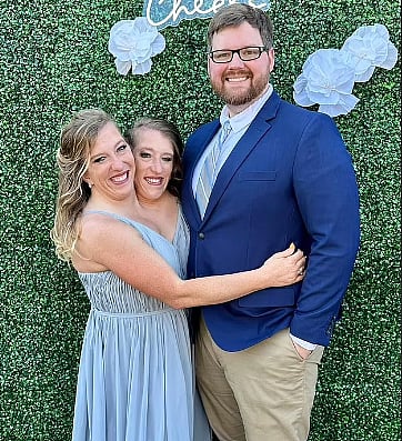 Conjoined Twins: ஓருடல், இரு தலை... ஒட்டிப்பிறந்த இரட்டையர்களின் திருமணம்: வைரல் வீடியோ!