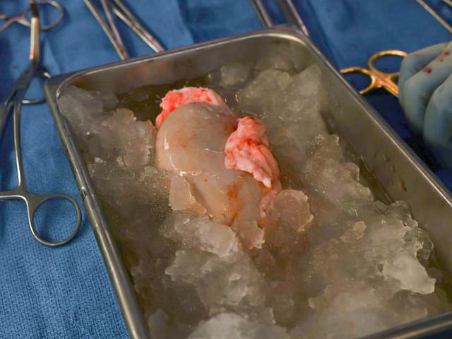 腎臓移植:ブタの腎臓移植を受けた最初の男性…なぜ彼は2か月以内に死亡したのですか? 、 腎臓移植:ブタの腎臓を移植された男性が死亡 1 豚の腎臓