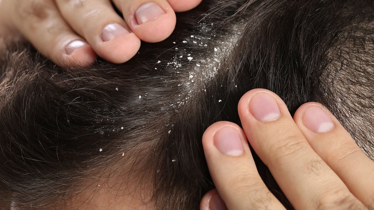 Dandruff: `பொடுகு அதிகமா இருக்கா?' தலைக்கு எண்ணெய் வைக்கலாமா; மருத்துவர் சொல்வெதன்ன?