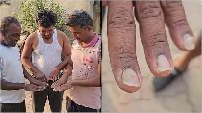 தொடரும் மர்மம்: முடி உதிர்ந்து வழுக்கையான கிராமத்தில் நகம் சேதமடைந்து விழுவதால் மக்கள் அதிர்ச்சி!