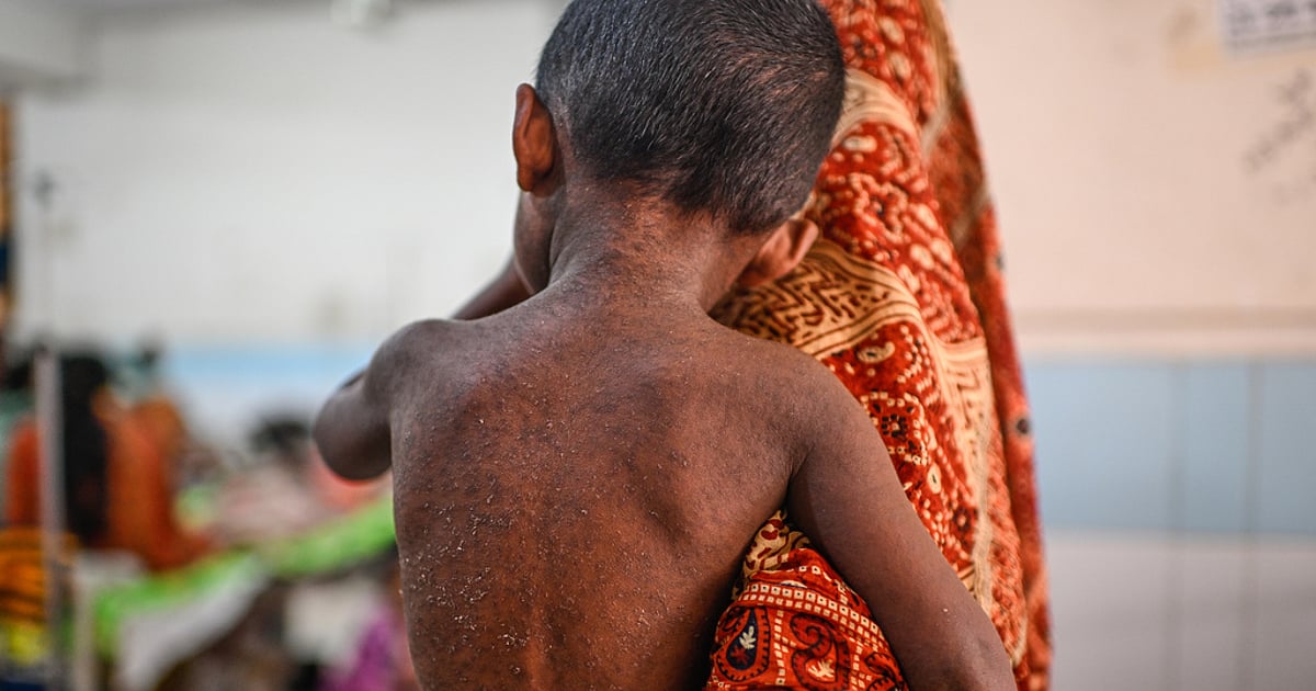 வங்கதேசத்தில் மீண்டும் வேகமெடுக்கும் தட்டம்மை ஆயிரத்தை நெருங்கிய உயிரிழப்புகள்! - அங்கு நிலைமை என்ன?