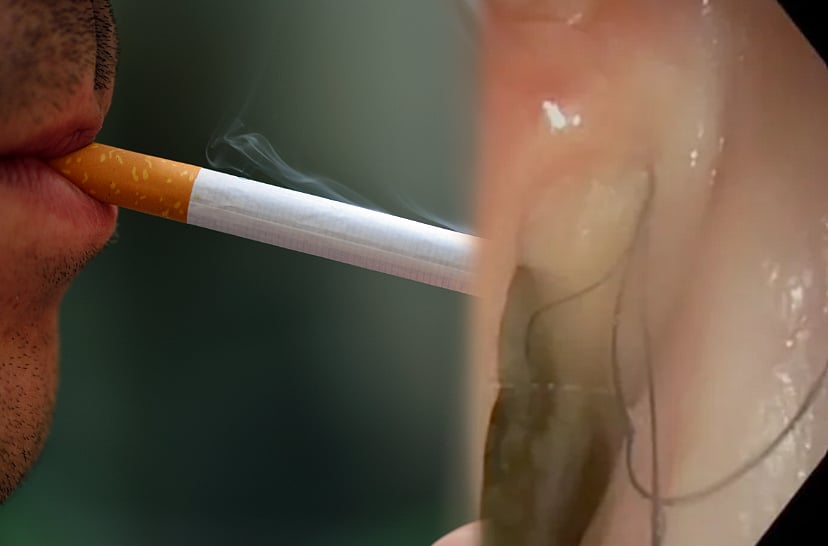 Smoking: புகைபிடிக்கும் பழக்கத்தால் தொண்டையில் வளர்ந்த முடி ...