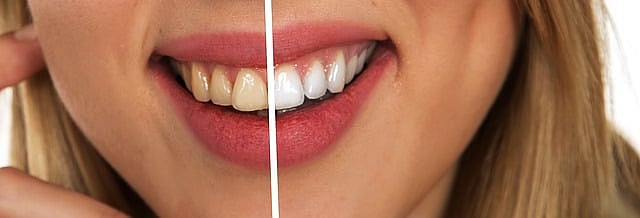 teeth whitening 