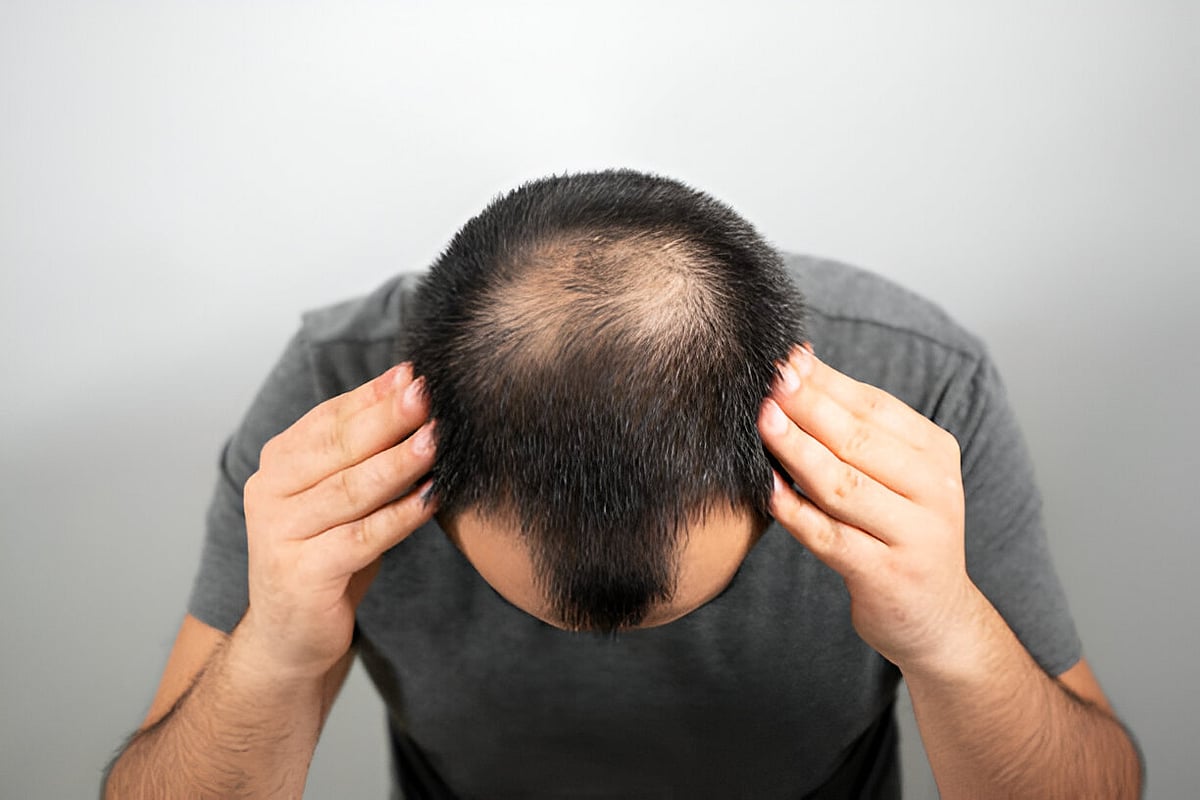 Hair fall: கொத்து கொத்தாக முடி உதிர்ந்தால் மறுபடியும் வளர வைக்க முடியுமா?
