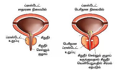 ``ஆண்களுக்கான கேன்சர் பரிசோதனை; இனி வீட்டிலேயே செய்யலாம் - ஆராய்ச்சியாளர்கள் சொல்வது என்ன?