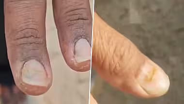தொடரும் மர்மம்: முடி உதிர்ந்து வழுக்கையான கிராமத்தில் நகம் சேதமடைந்து விழுவதால் மக்கள் அதிர்ச்சி!