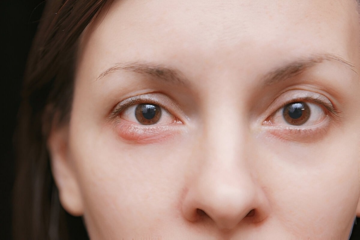 Eye Health: கண்களில் வருகிற கட்டிக்கு நாமக்கட்டி உரசிப் பூசலாமா?