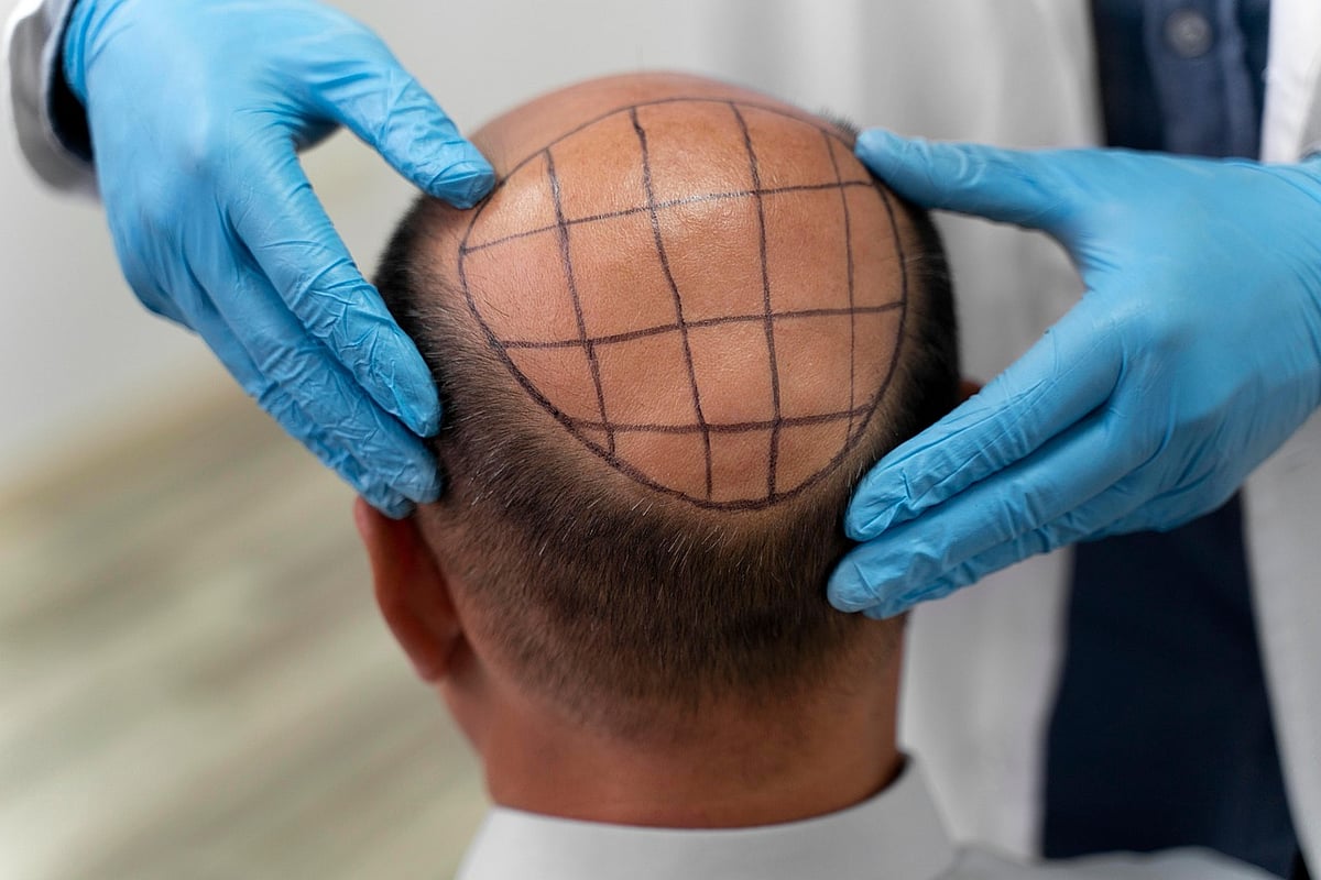 Hair: முடி மாற்று அறுவை சிகிச்சையால் சோகம்; `பாக்டீரியா தொற்றால் அவதி - மருத்துவர் மீது புகார்!
