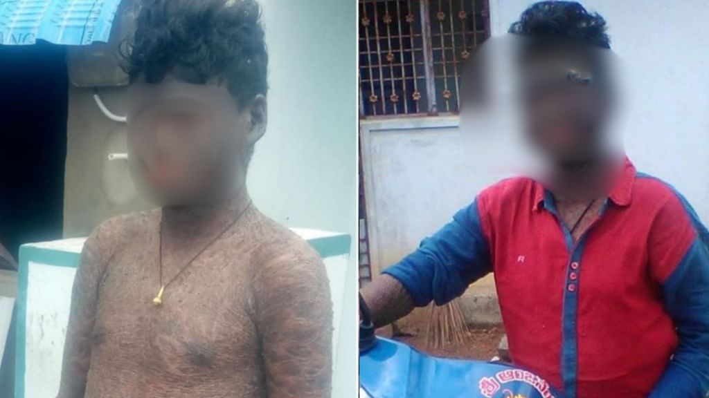 தோல் நோயால் பாதிக்கப்பட்டுள்ள இளைஞர்