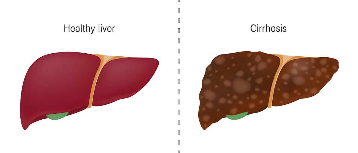 கல்லீரல் அழற்சி நோய் (Liver Cirrhosis) என்றால் என்ன?
