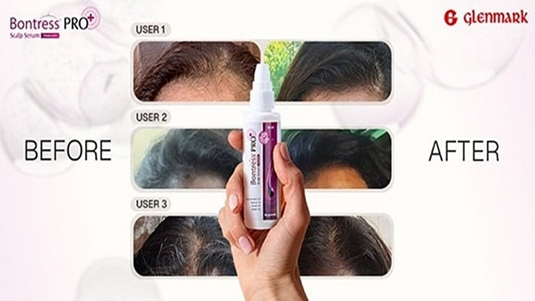 வீட்டு வைத்தியங்களை தாண்டி யோசிப்போம்: முடி உதிர்வுக்கு சரியான தீர்வு எது?