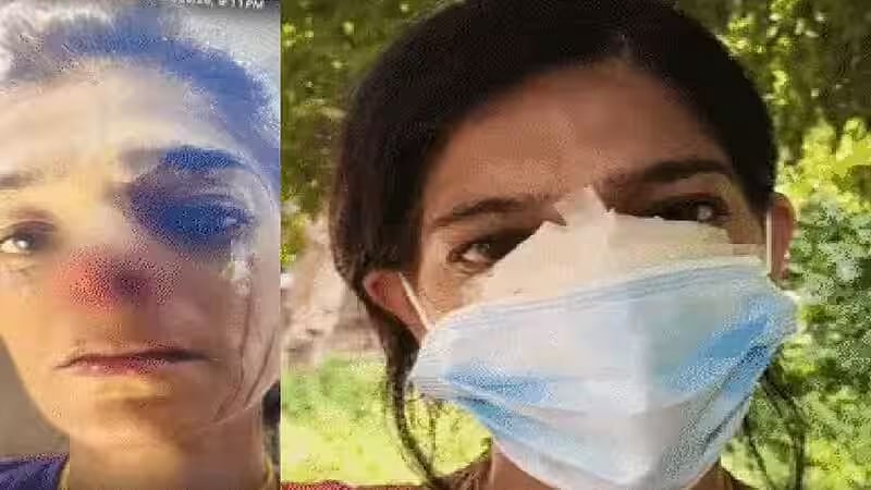 பிச்சை போட மறுத்த பெண்; மூக்கைக் கடித்து மூக்குத்தியைப் பறித்த யாசகர்; உத்தரப்பிரதேசத்தில் துணிகரம்