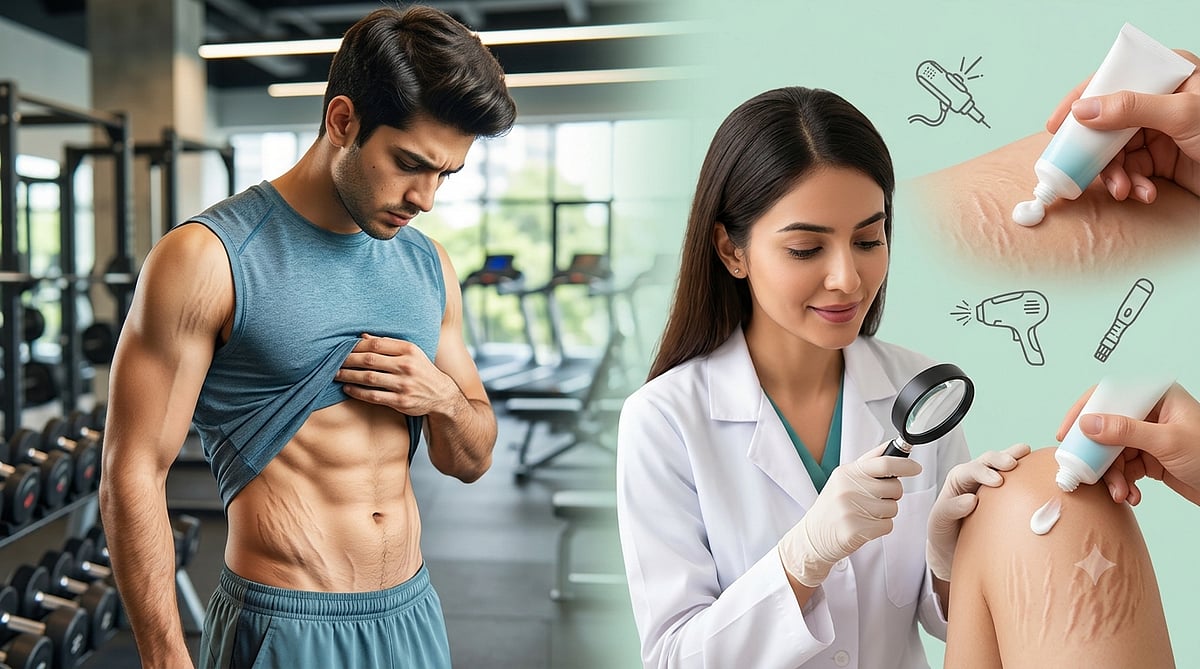 Doctor Vikatan: 20 வயது மகனுக்கு வெயிட்லாஸால் ஏற்பட்ட  Stretch Marks... மாறுமா, நிரந்தரமா?